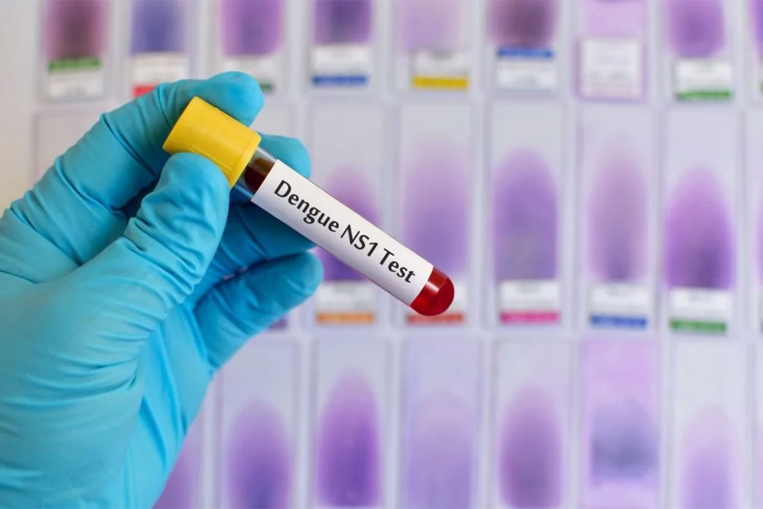En 385 % suben los casos de dengue en México: Crece alerta ante la temporada de huracanes
