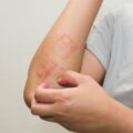 Estas son las diferencias entre herpes, hongos, sarpullidos y VPH