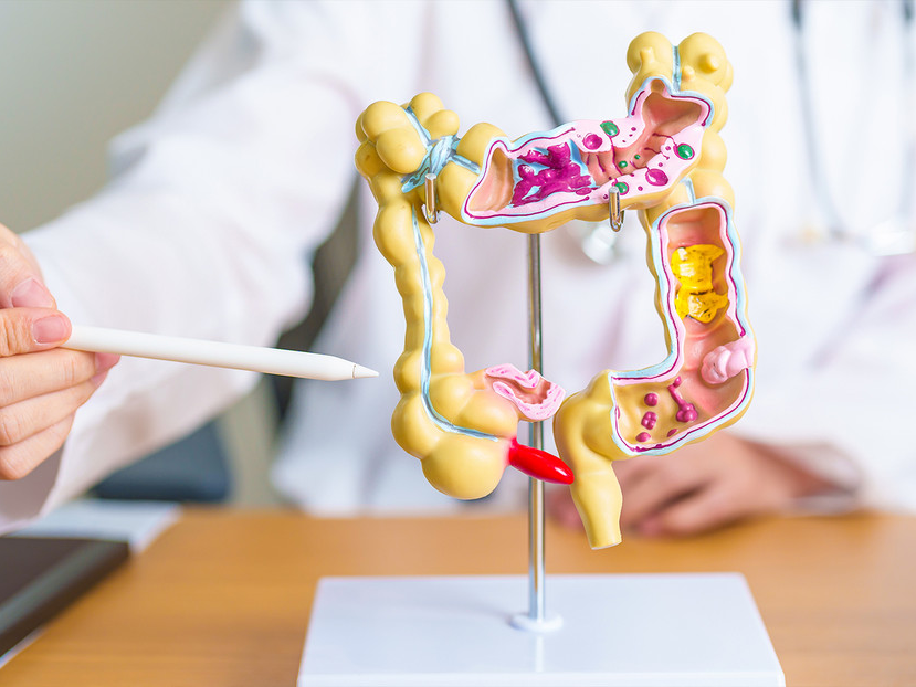 Hábitos que ayudan a prevenir el cáncer de colon